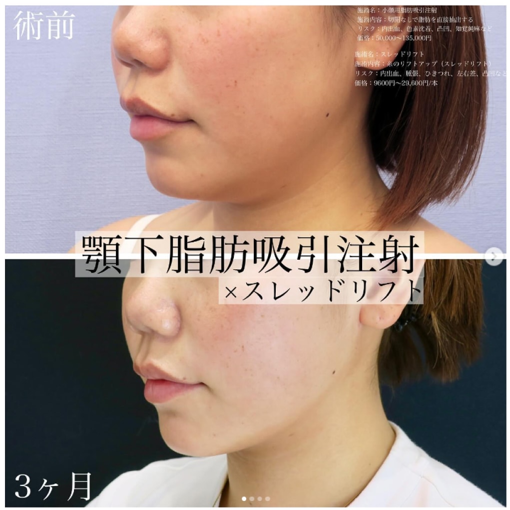 脂肪吸引注射の症例